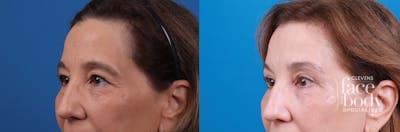 Eyelid Surgery Before & After Gallery - Patient 361650 - Image 1