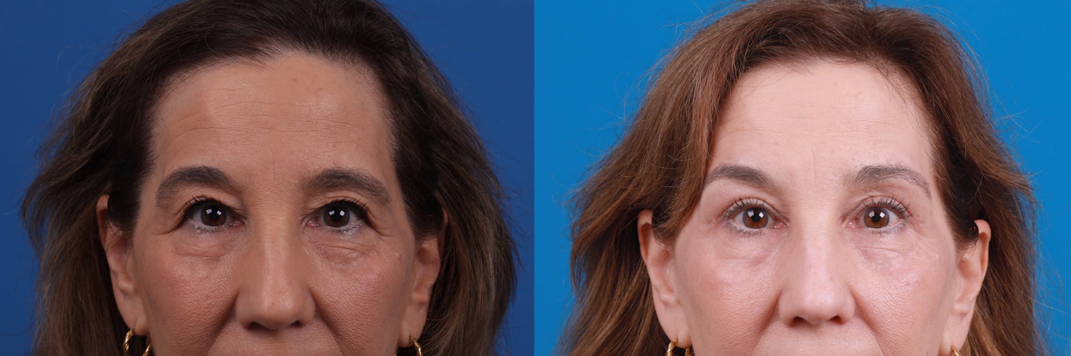Eyelid Surgery Before & After Gallery - Patient 122444868 - Image 2
