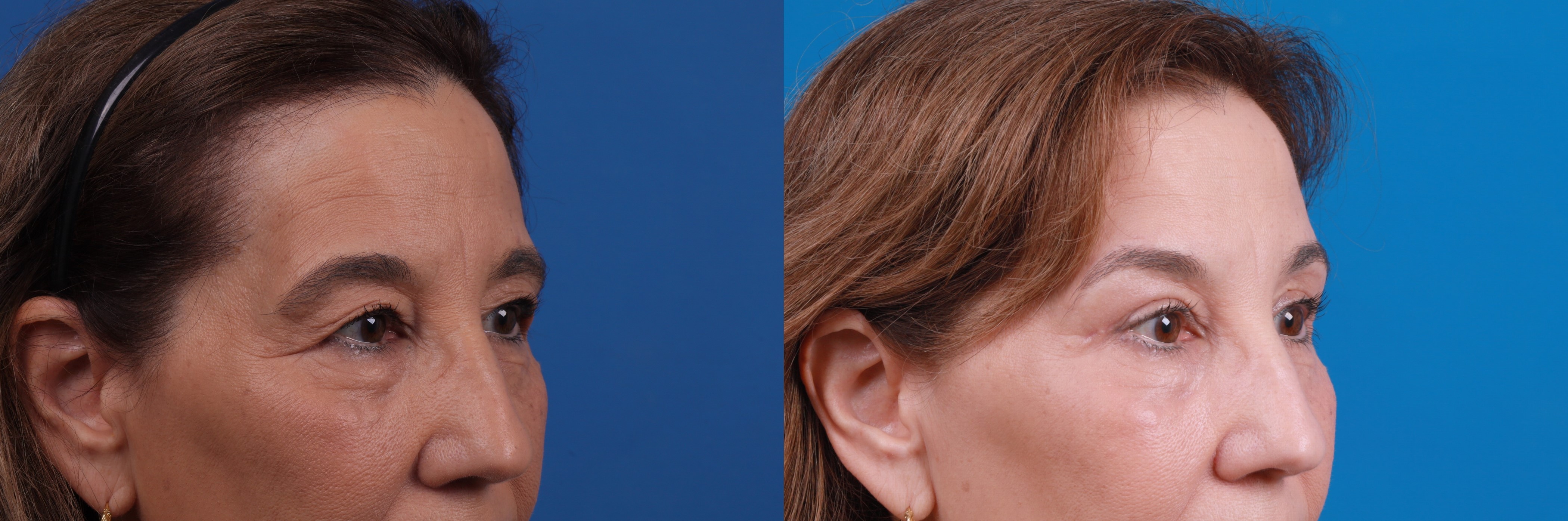 Eyelid Surgery Before & After Gallery - Patient 361650 - Image 3