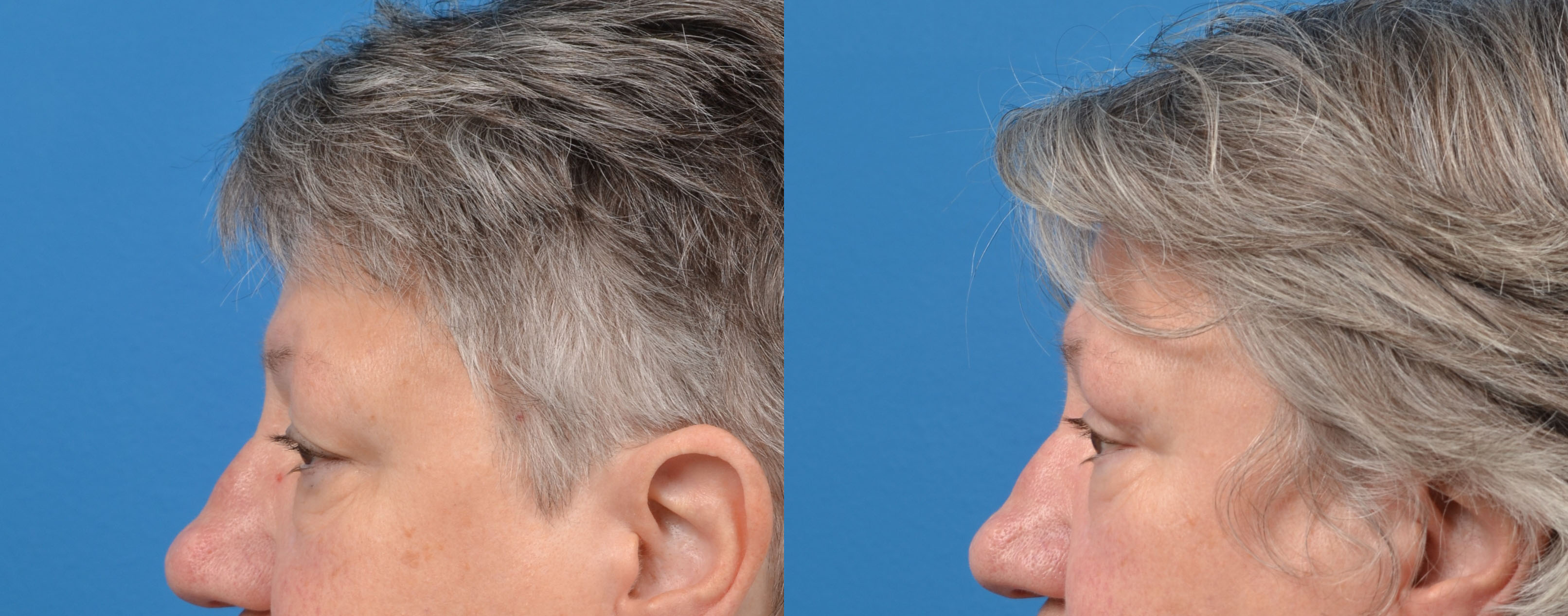 Eyelid Surgery Before & After Gallery - Patient 395877 - Image 4