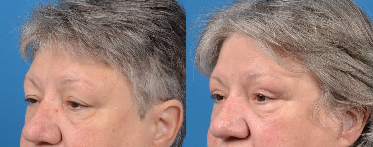 Eyelid Surgery Before & After Gallery - Patient 122444687 - Image 3