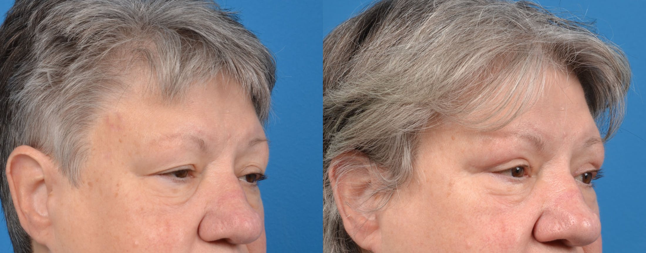 Eyelid Surgery Gallery - Patient 122444687 - Image 2