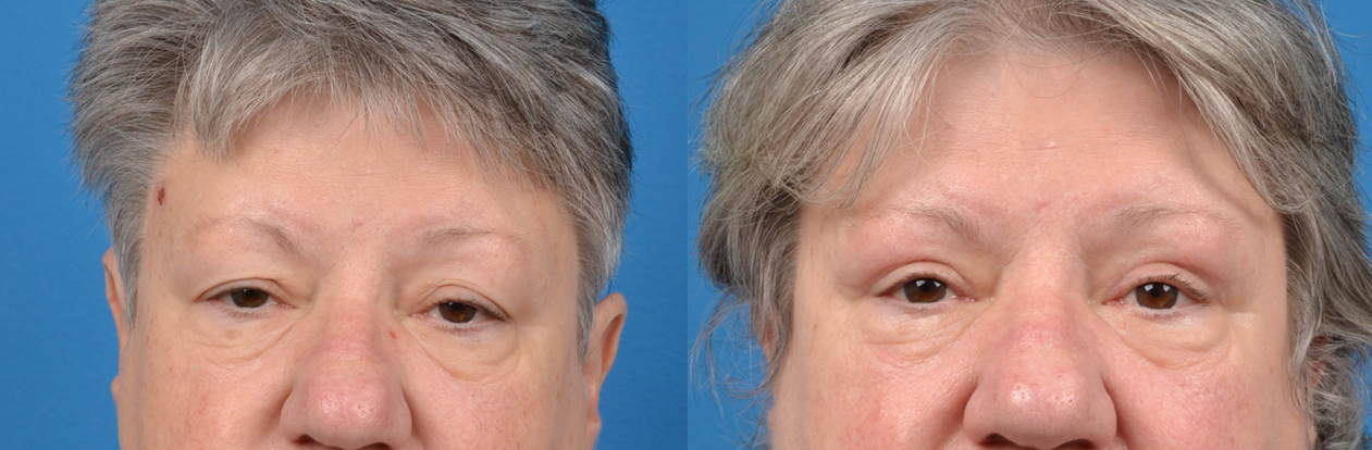 Eyelid Surgery Before & After Gallery - Patient 395877 - Image 1