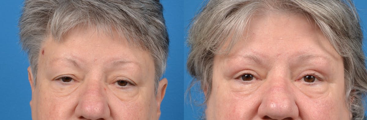 Eyelid Surgery Before & After Gallery - Patient 122444687 - Image 1