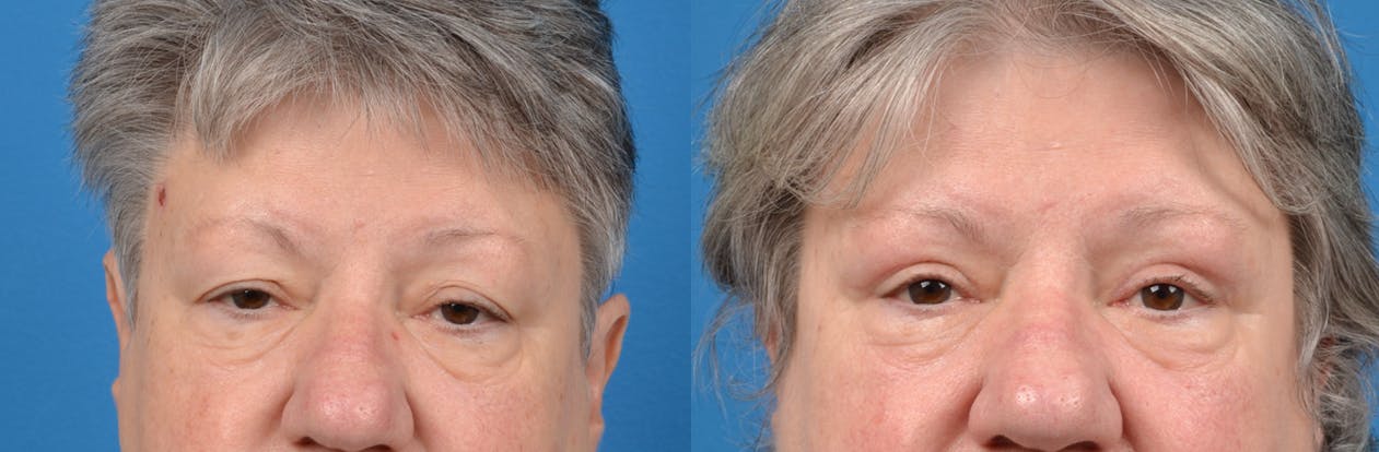Eyelid Surgery Gallery - Patient 122444687 - Image 1