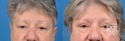 Eyelid Surgery Before & After Gallery - Patient 395877 - Image 1
