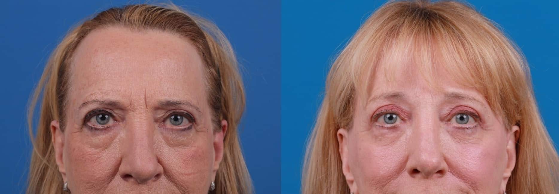 Eyelid Surgery Before & After Gallery - Patient 122592563 - Image 2