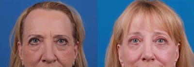 Brow Lift Before & After Gallery - Patient 122591774 - Image 1