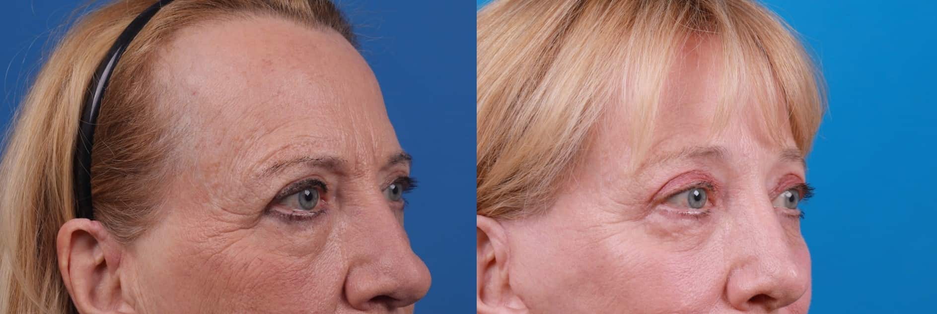 Eyelid Surgery Before & After Gallery - Patient 171801 - Image 3