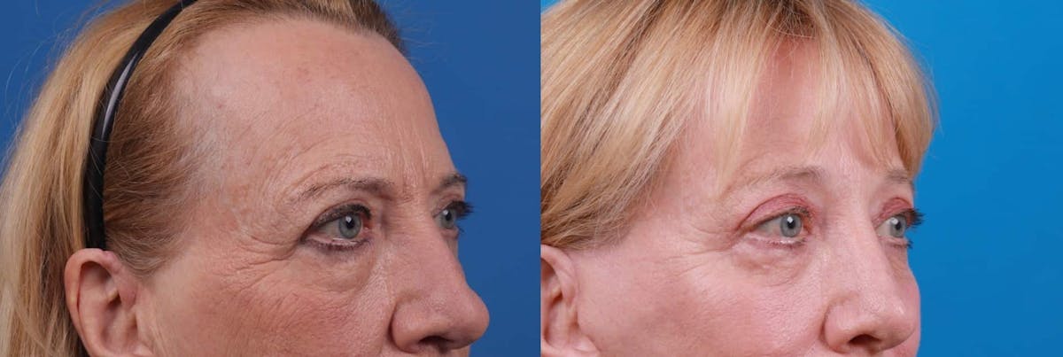 Eyelid Surgery Before & After Gallery - Patient 122592563 - Image 3