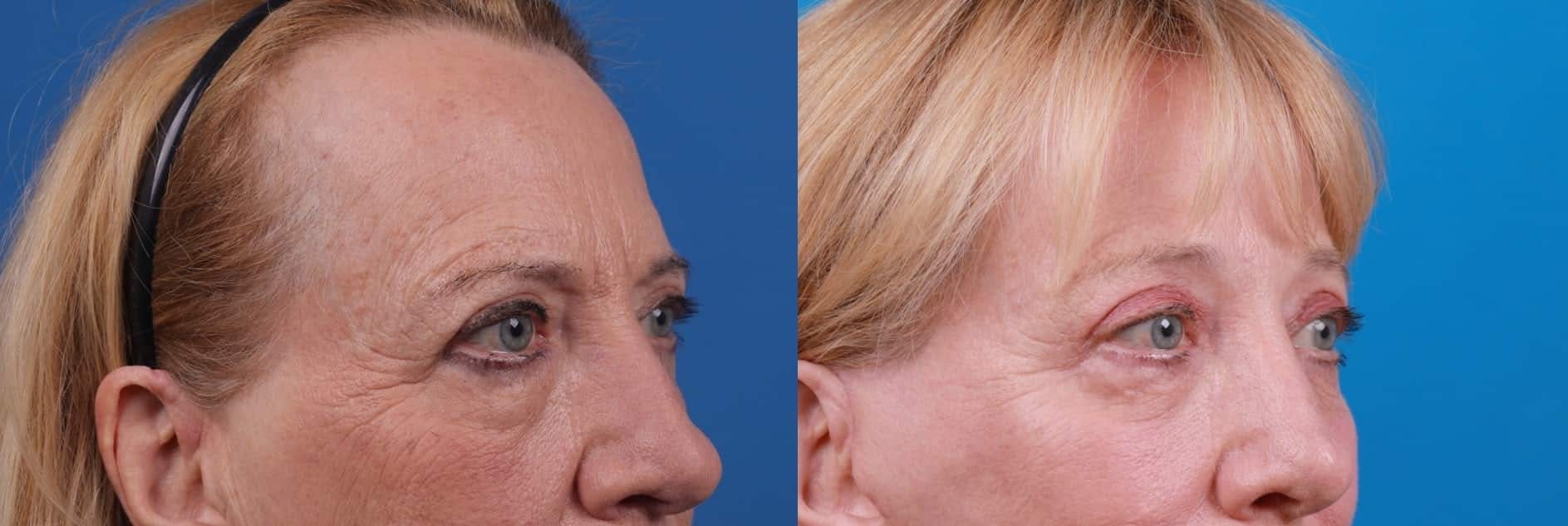 Eyelid Surgery Before & After Gallery - Patient 122592563 - Image 3
