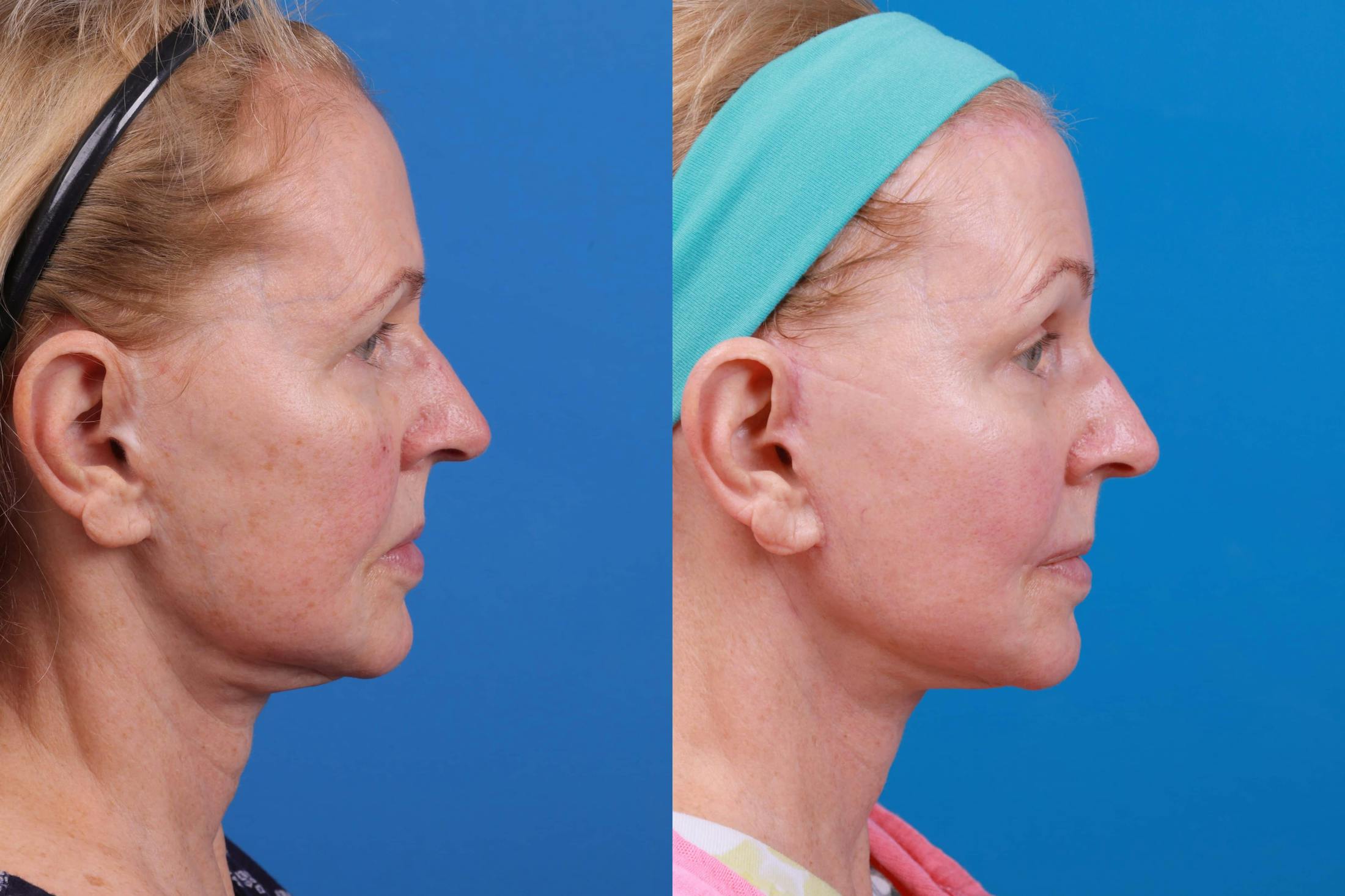 Express Lift Before & After Gallery - Patient 122591993 - Image 1