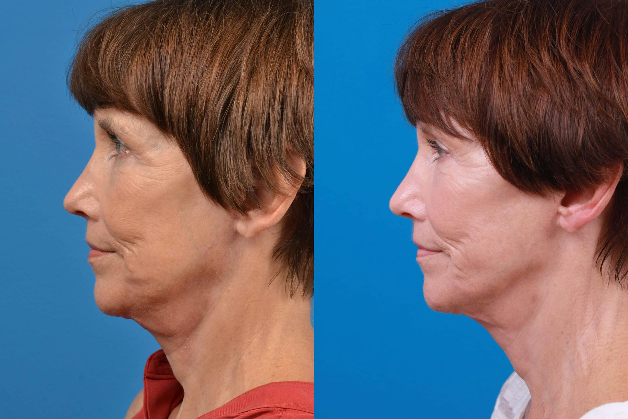 Express Lift Before & After Gallery - Patient 122591995 - Image 1