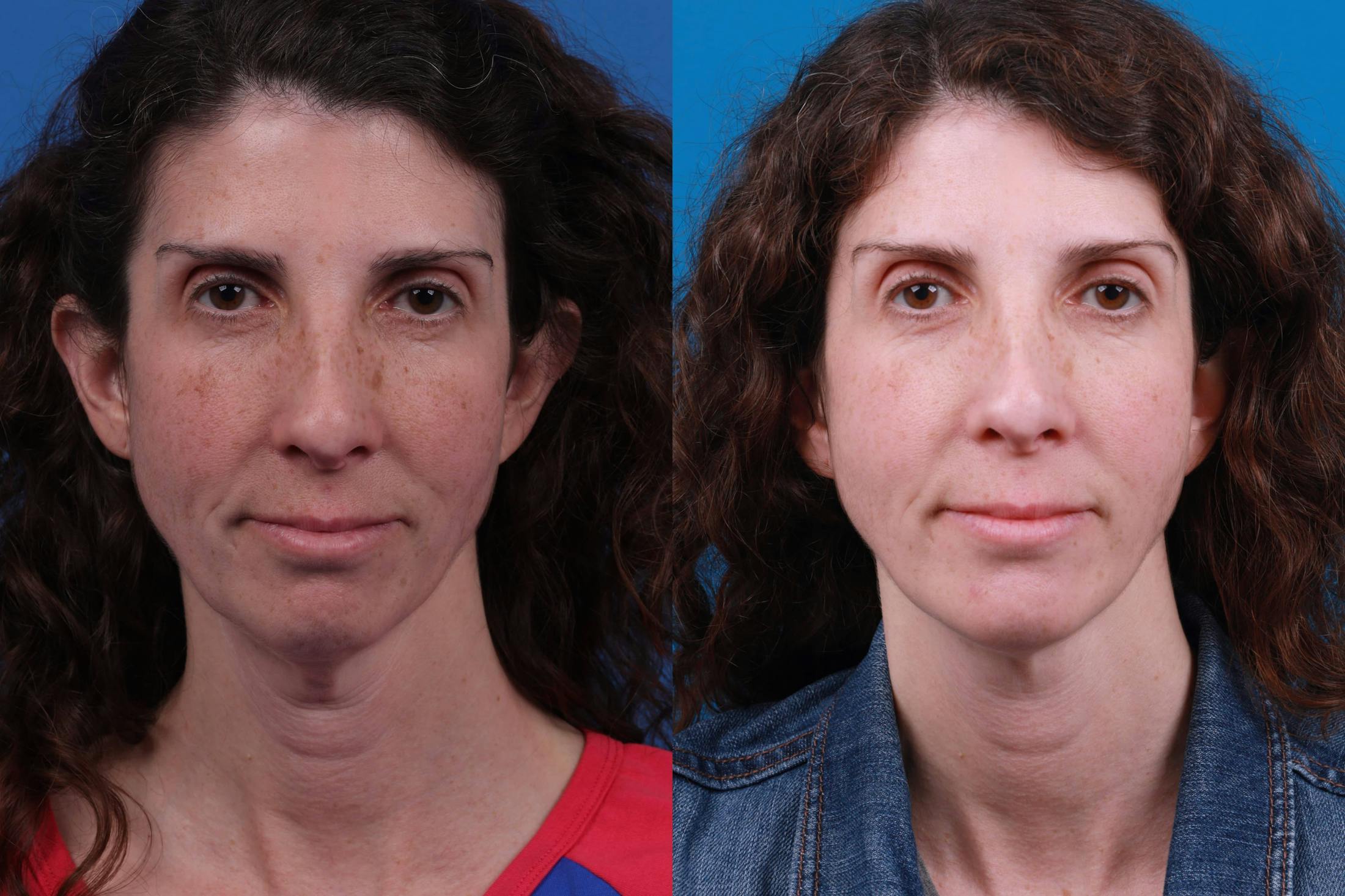 Express Lift Before & After Gallery - Patient 122591998 - Image 1