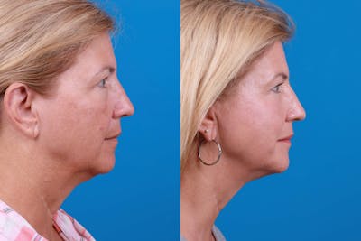 Express Lift Before & After Gallery - Patient 122591996 - Image 1