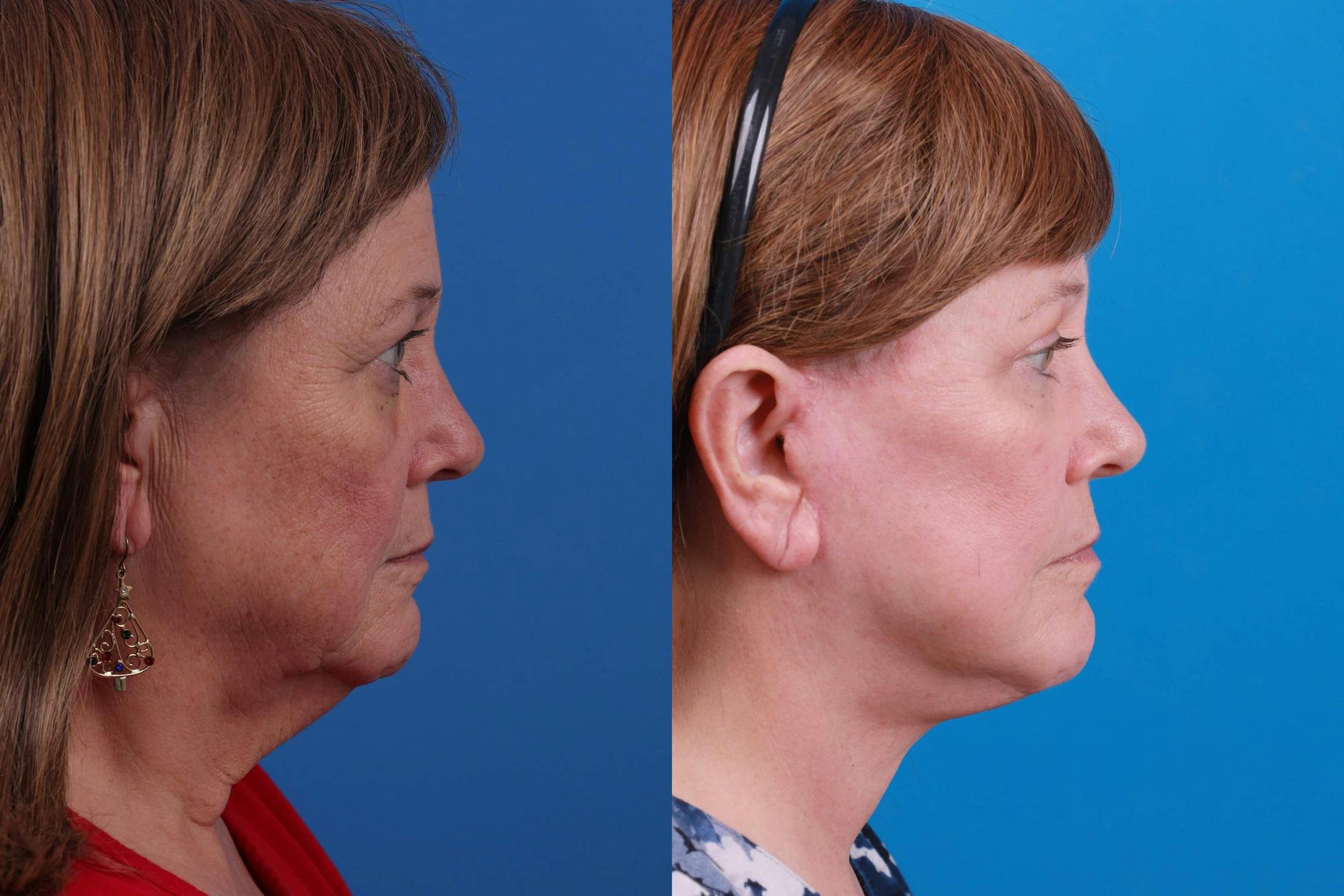 Facelift Before & After Gallery - Patient 122593605 - Image 5