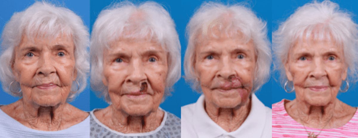 Mohs Surgery and Skin Cancer Before & After Gallery - Patient 122593785 - Image 1
