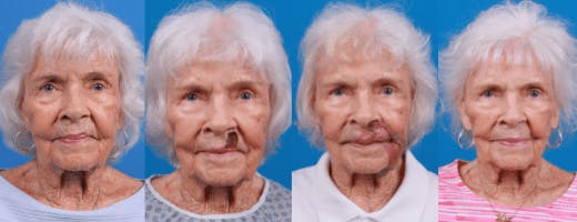 Mohs Surgery and Skin Cancer Before & After Gallery - Patient 122593785 - Image 1