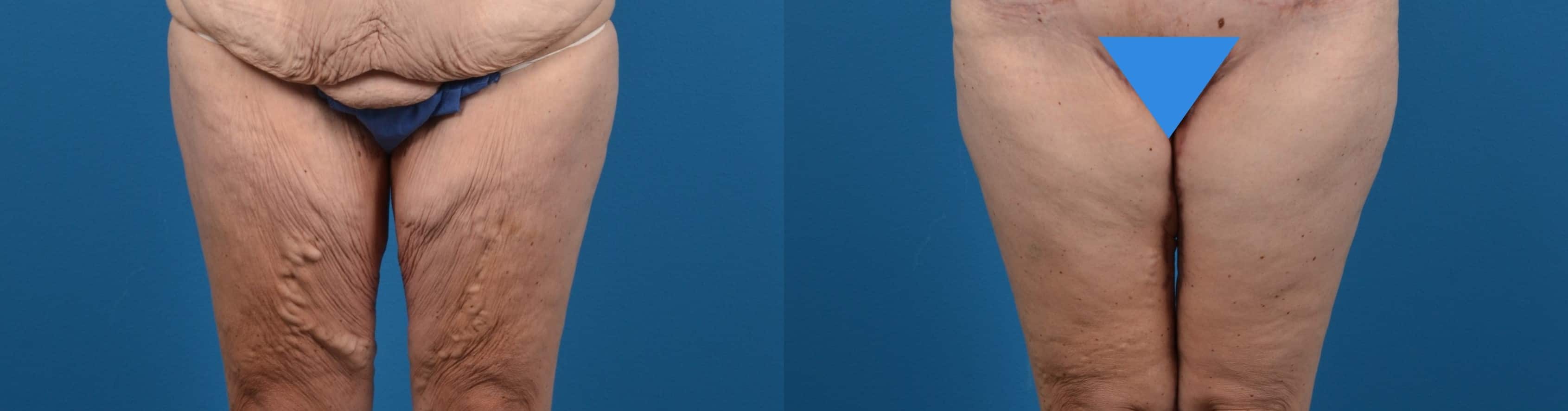 Hidden Thigh Lift Before & After Gallery - Patient 122594059 - Image 1