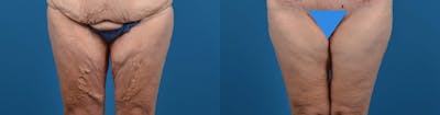 Thigh Lift Before & After Gallery - Patient 207974 - Image 1