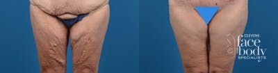 Hidden Thigh Lift Before & After Gallery - Patient 149470 - Image 1