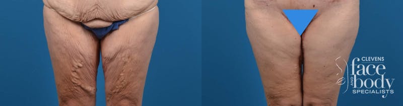 Hidden Thigh Lift Before & After Gallery - Patient 149470 - Image 1