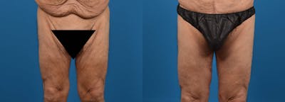 Thigh Lift Before & After Gallery - Patient 389485 - Image 1