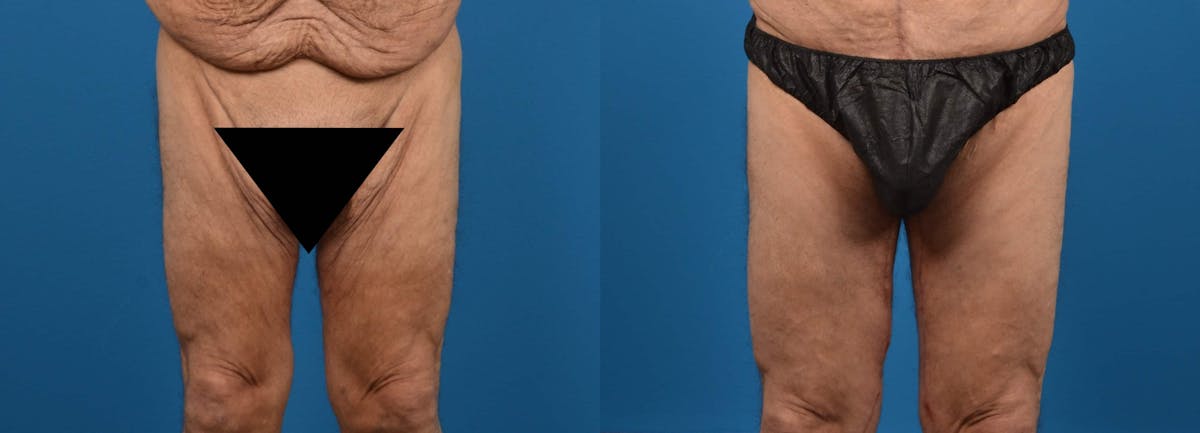 Thigh Lift Before & After Gallery - Patient 122594061 - Image 1