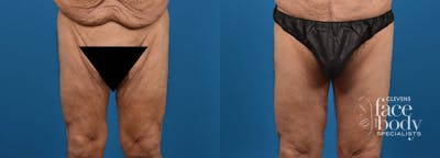 Hidden Thigh Lift Before & After Gallery - Patient 183851 - Image 1