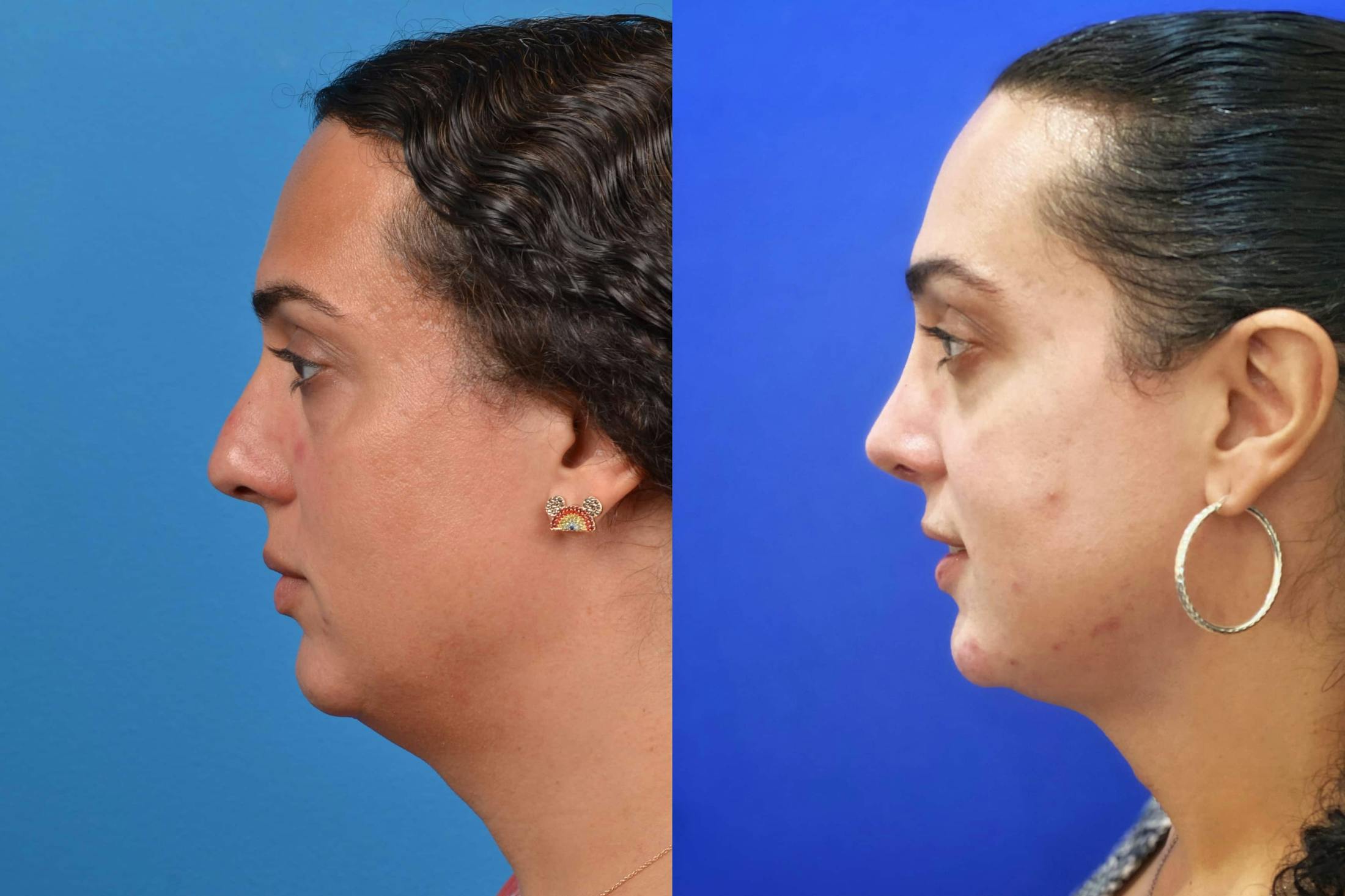 Facial Feminization Before & After Gallery - Patient 122595433 - Image 4