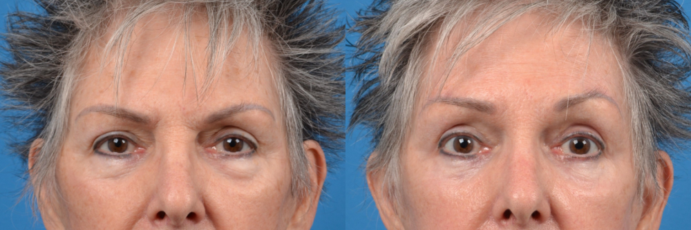 Eyelid Surgery Before & After Gallery - Patient 211956 - Image 1