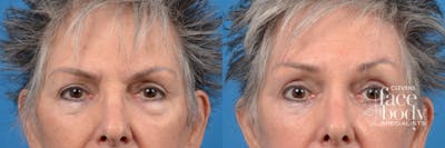 Eyelid Surgery Before & After Gallery - Patient 211956 - Image 1