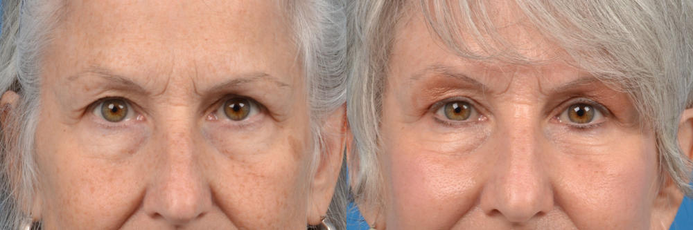 Eyelid Surgery Before & After Gallery - Patient 175230 - Image 1