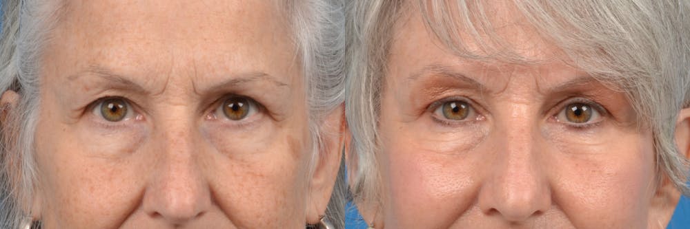 Eyelid Surgery Before & After Gallery - Patient 122444732 - Image 1