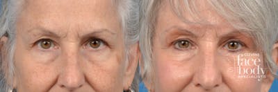 Eyelid Surgery Before & After Gallery - Patient 175230 - Image 1