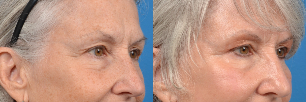 Eyelid Surgery Before & After Gallery - Patient 175230 - Image 2