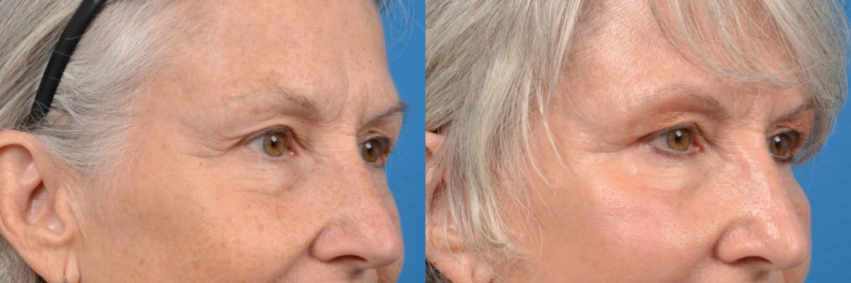 Eyelid Surgery Before & After Gallery - Patient 122444732 - Image 2