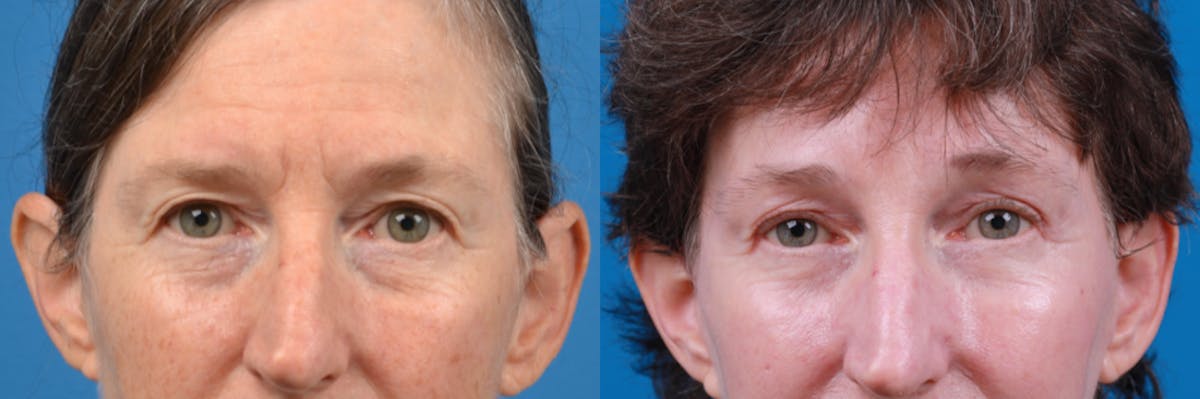 Eyelid Surgery Before & After Gallery - Patient 122444779 - Image 2