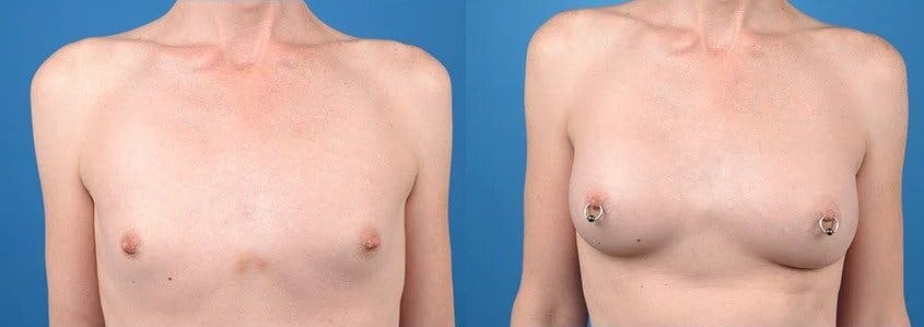 Male to Female Top Surgery Before & After Gallery - Patient 122655192 - Image 1