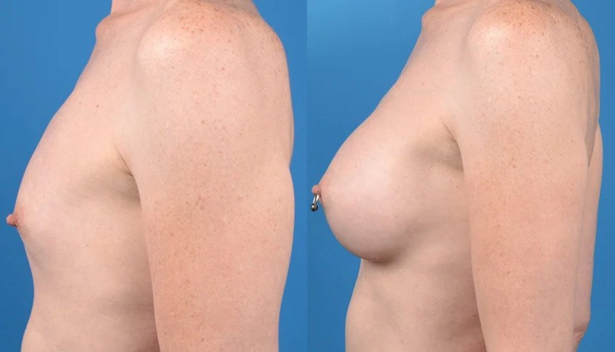 Male to Female Top Surgery Before & After Gallery - Patient 122655192 - Image 2