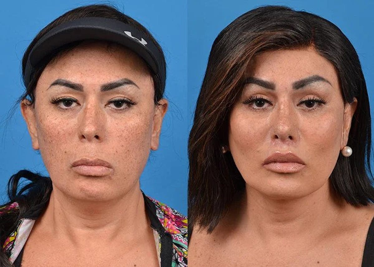 Facial Feminization Before & After Gallery - Patient 122655512 - Image 1