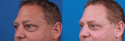 Male Eyelid Surgery Before & After Gallery - Patient 122406382 - Image 1