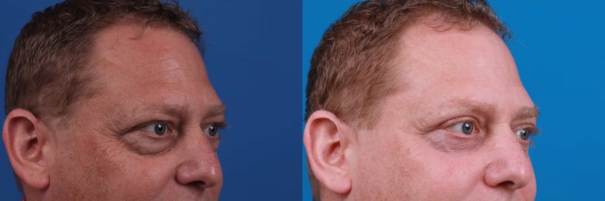 Male Eyelid Surgery Before & After Gallery - Patient 122406382 - Image 2