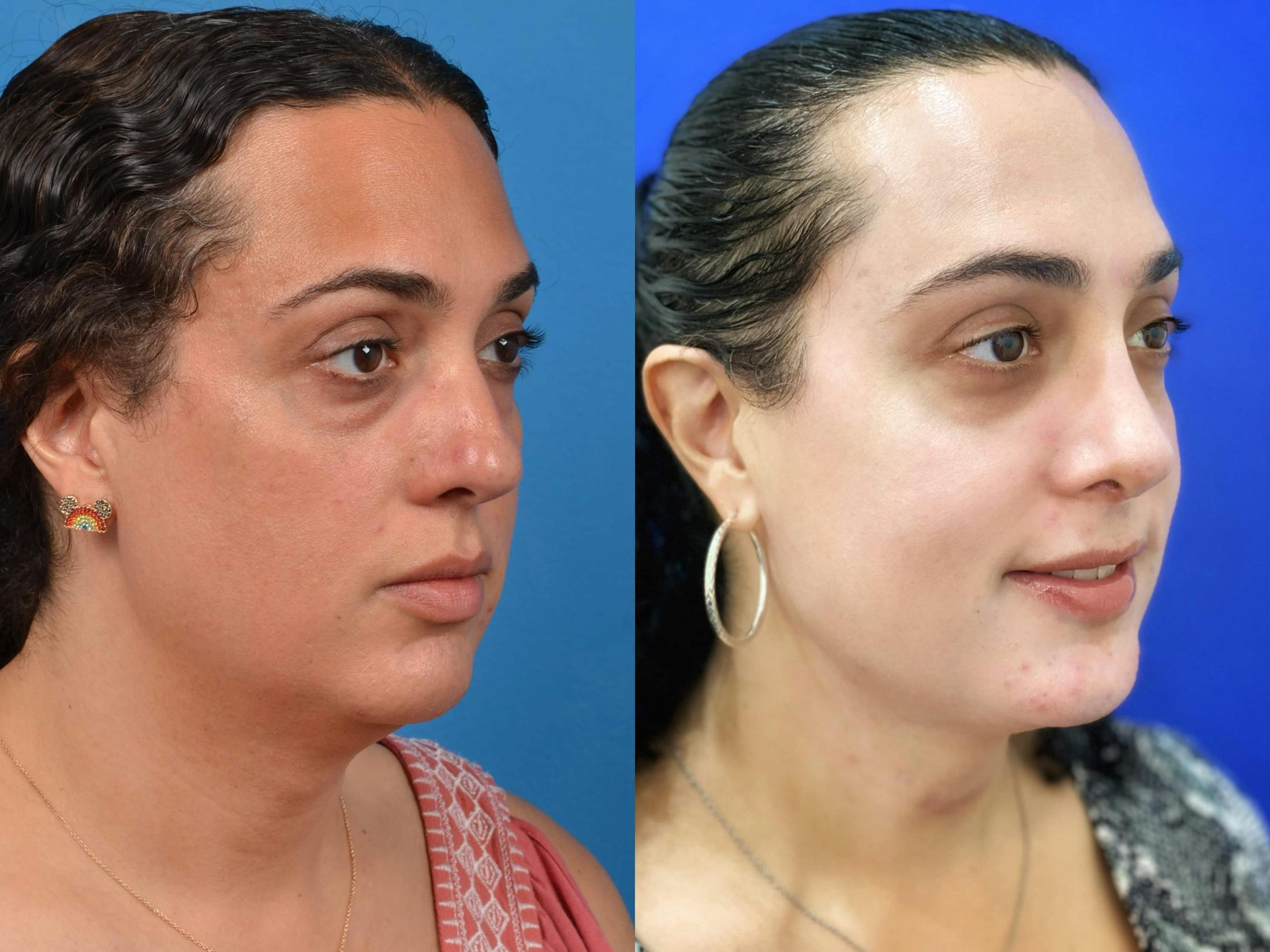 Facial Feminization Before & After Gallery - Patient 122595433 - Image 2
