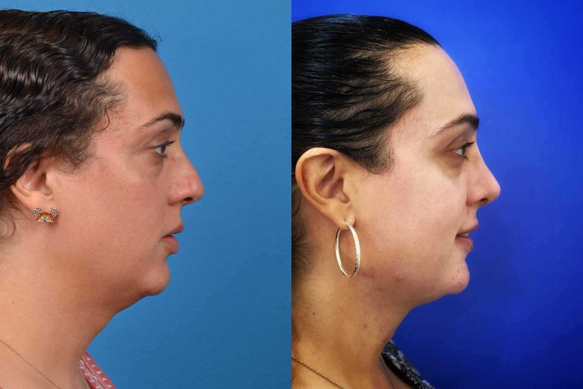 Facial Feminization Before & After Gallery - Patient 122595433 - Image 3