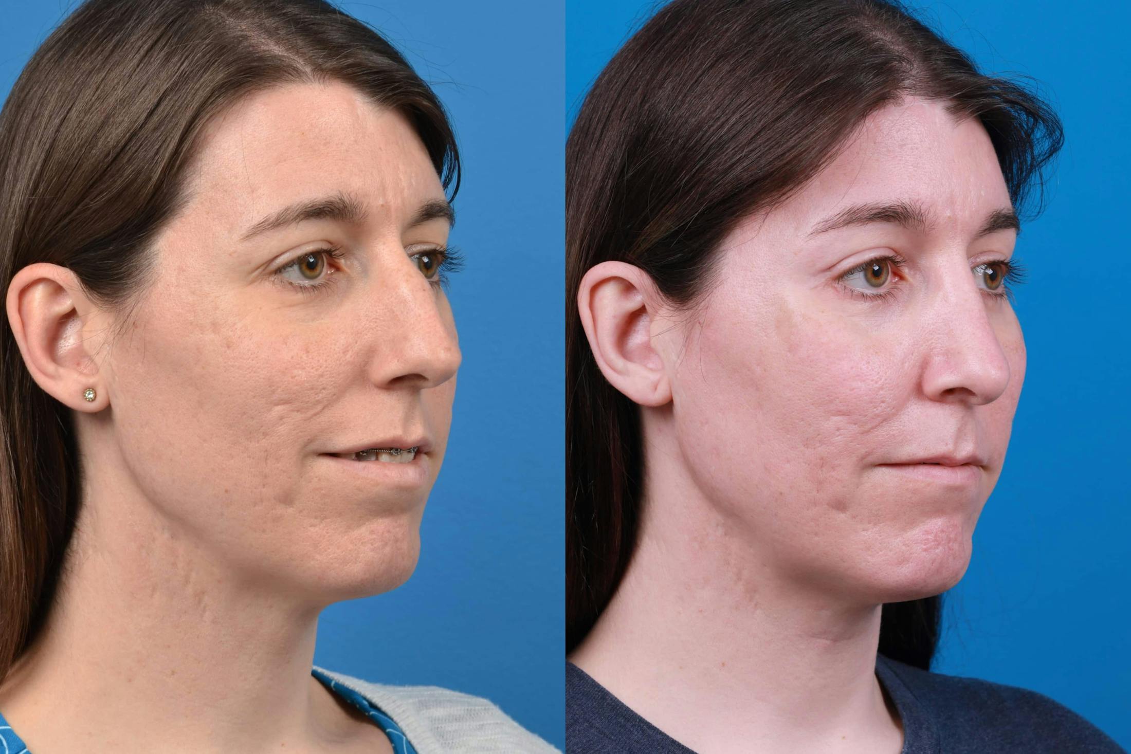 Facial Feminization Before & After Gallery - Patient 122595434 - Image 4