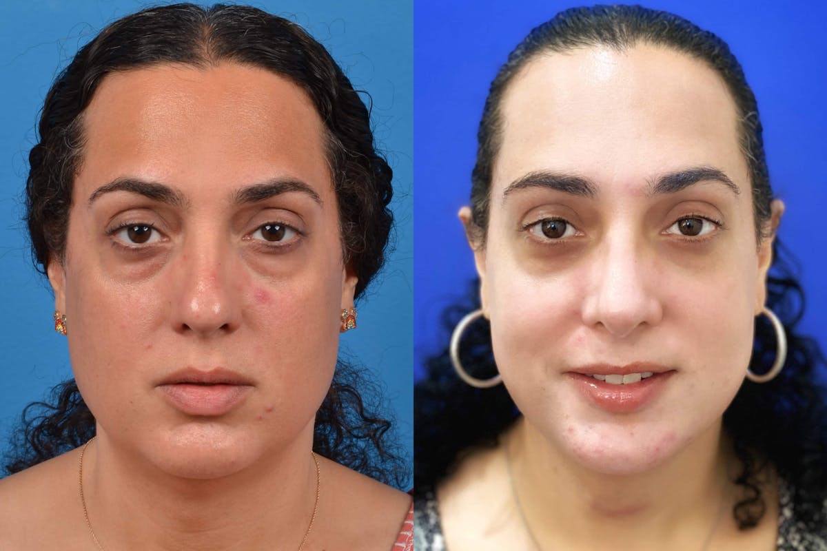 Facial Feminization Before & After Gallery - Patient 122595433 - Image 5