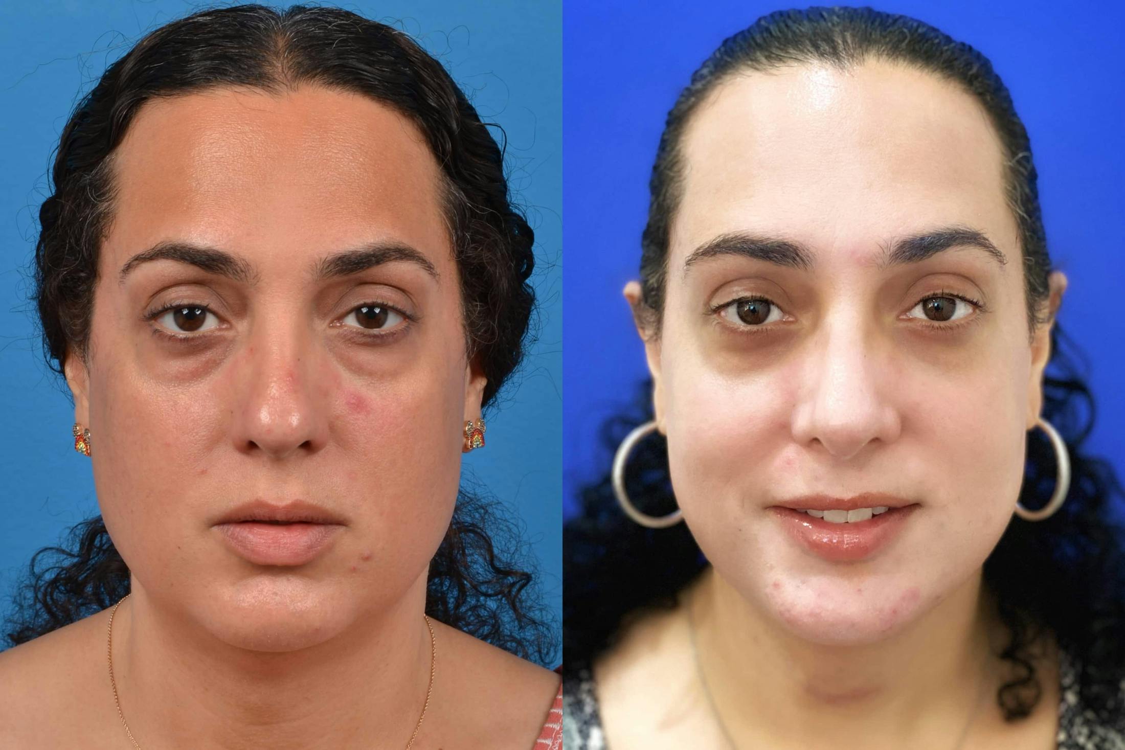 Facial Feminization Before & After Gallery - Patient 122595433 - Image 5