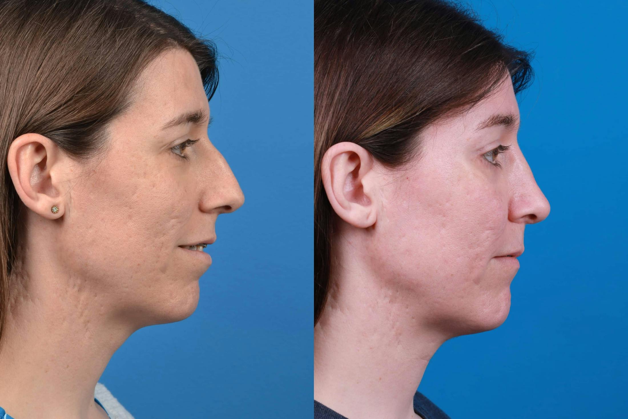 Facial Feminization Before & After Gallery - Patient 122595434 - Image 5