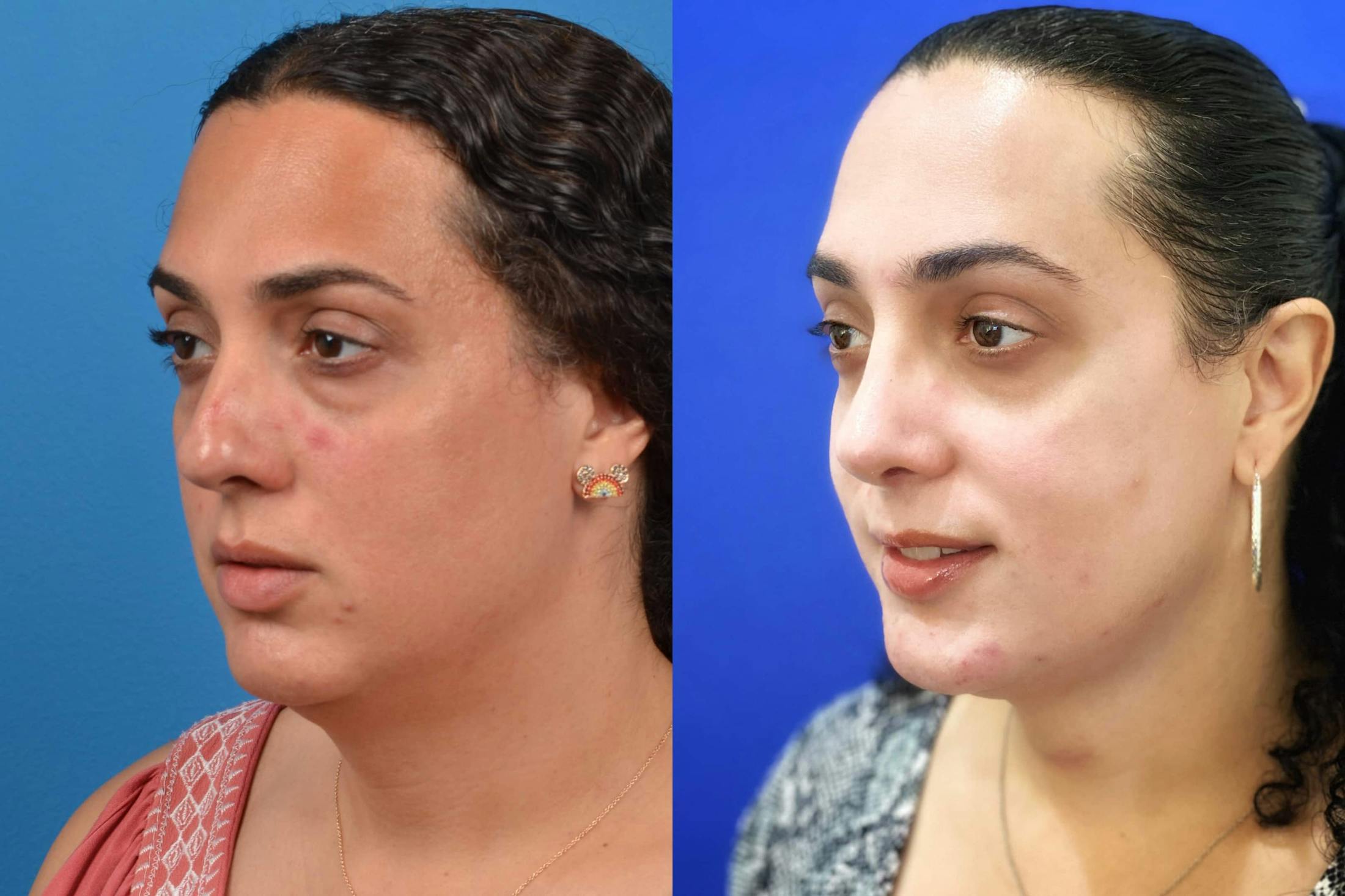 Facial Feminization Before & After Gallery - Patient 122595433 - Image 1